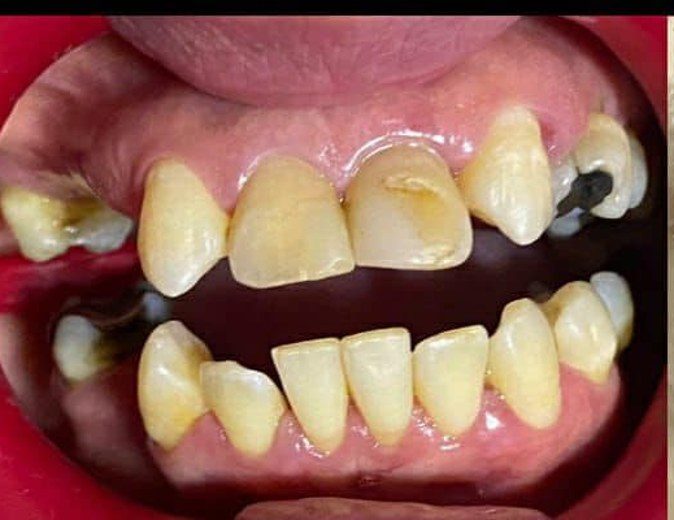Antes: dientes de adelante dañados
