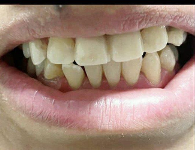 Después: dientes de adelante restaurados
