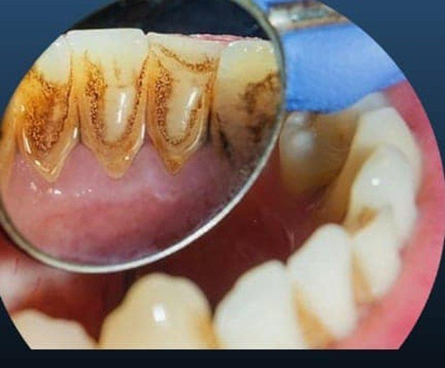 Antes: sarro en los dientes de abajo