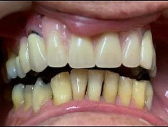 Después: dientes superiores completos