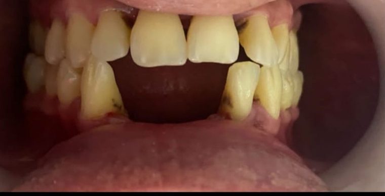 Antes: espacio sin dientes