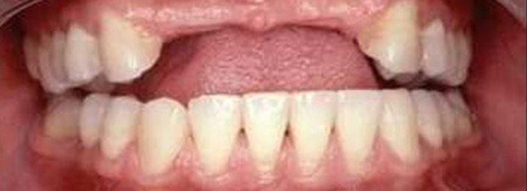 Antes: faltan los dientes de adelante