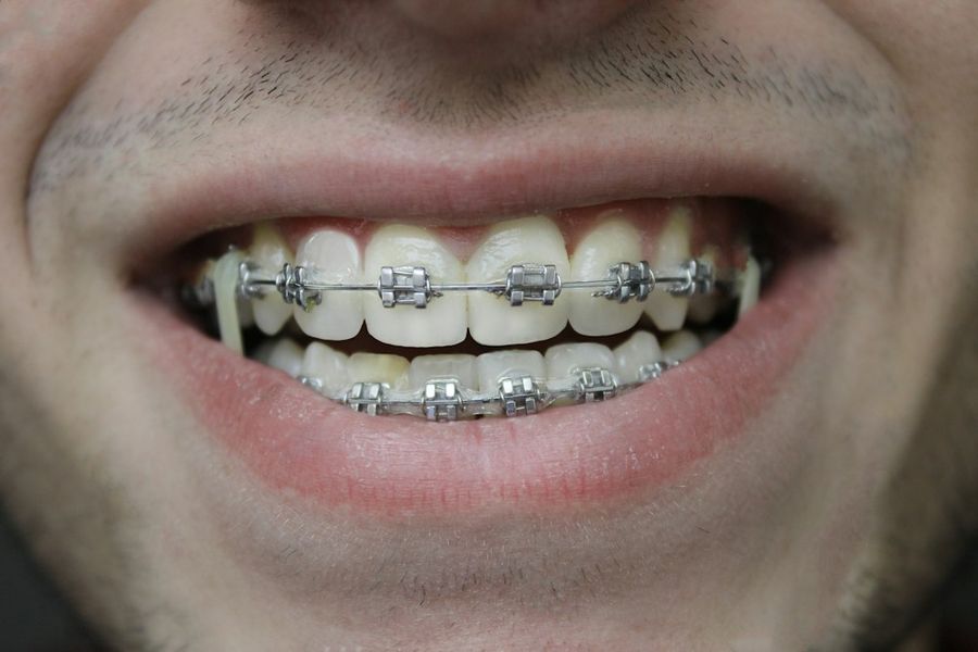 Sonrisa con brackets